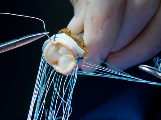 La tecnica “Origami” per sostituire la valvola aortica