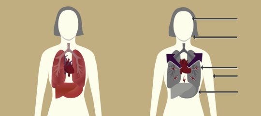 L’infarto del miocardio