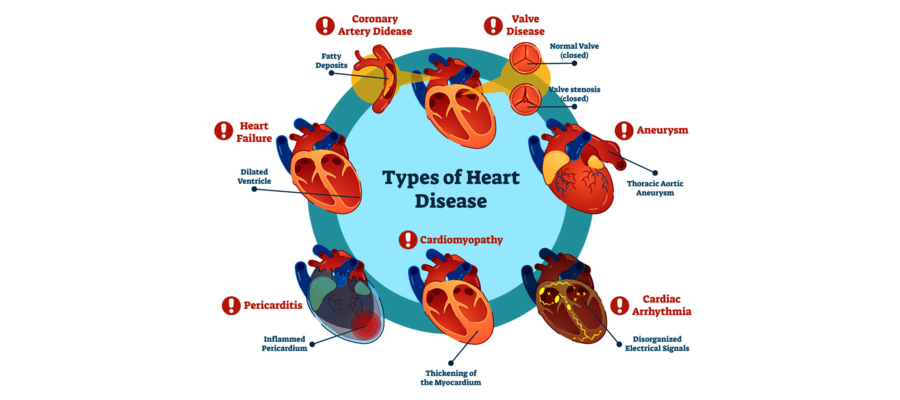 Come Si Complica L Infarto