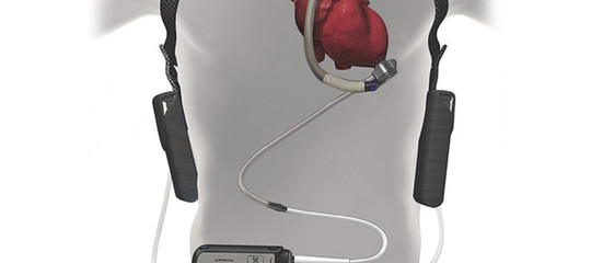 Funziona sempre meglio il “cuore artificiale di riserva”