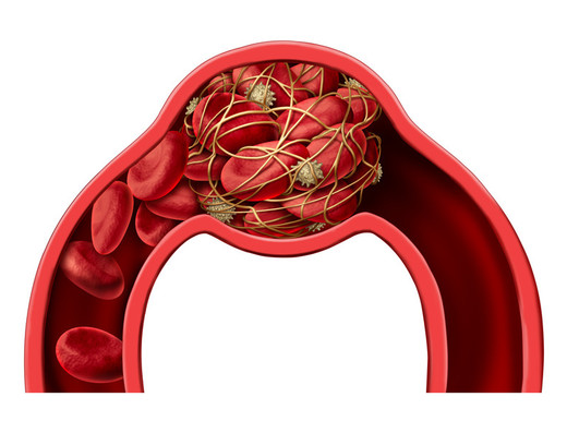 Cos’è il tromboembolismo venoso?