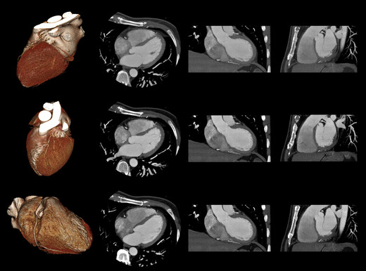 Tac o coronarografia per studiare le arterie del cuore?