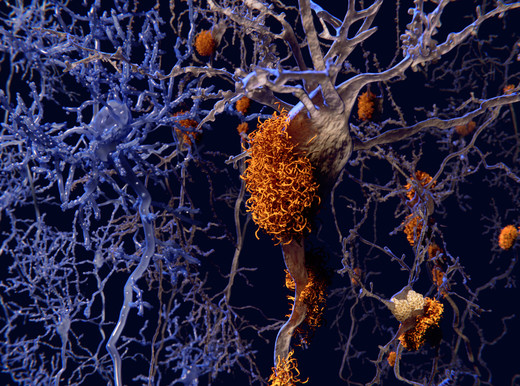 Svelato il segreto dell’amiloidosi cardiaca