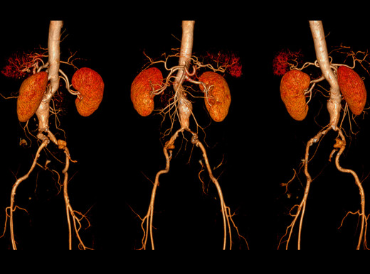 Svelati i geni dell’aneurisma dell’aorta addominale