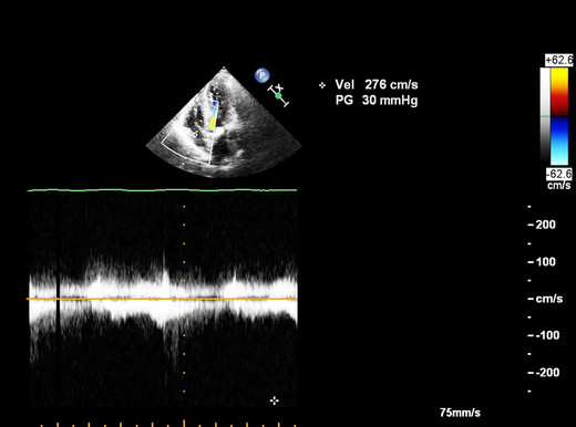 Ecocardiogramma e test mirati per svelare il rischio cuore dopo chemioterapia