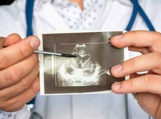 Così l’adroterapia cura le gravi aritmie del ventricolo