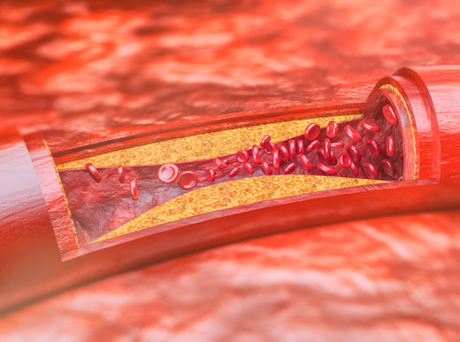 Aterosclerosi, una spia nel sangue la scopre quando non dà segni