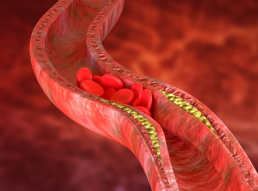 Aterosclerosi, nuovi marcatori dei lipidi informano sul rischio infarto