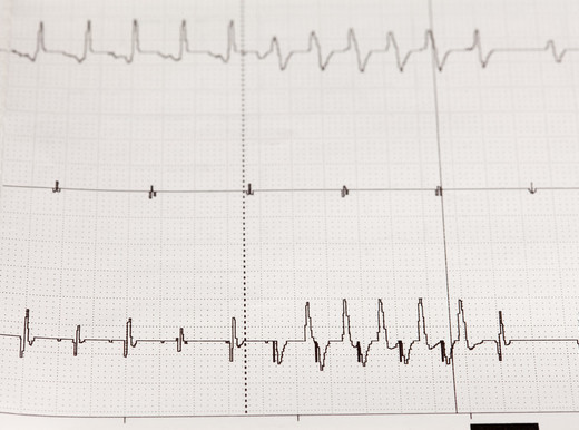 In arrivo la collana intelligente che scopre la fibrillazione atriale