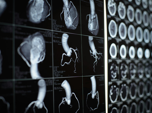 I cardiologi italiani indicano il miglior trattamento dell’infarto a coronaria non completamente chiusa