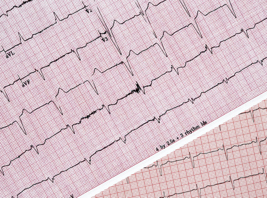 Fibrillazione atriale, soddisfacente sicurezza degli anticoagulanti orali