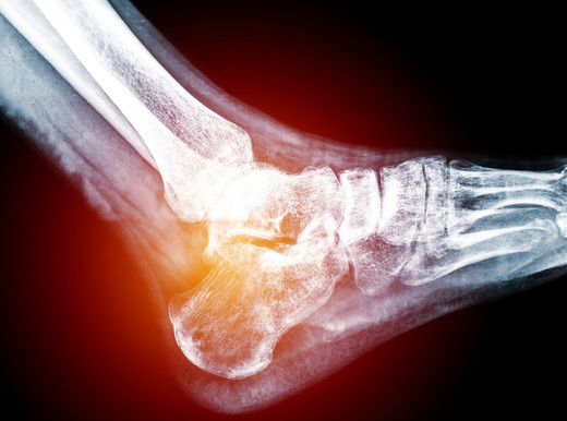 L’osteoporosi potrebbe aumentare il rischio d’infarto