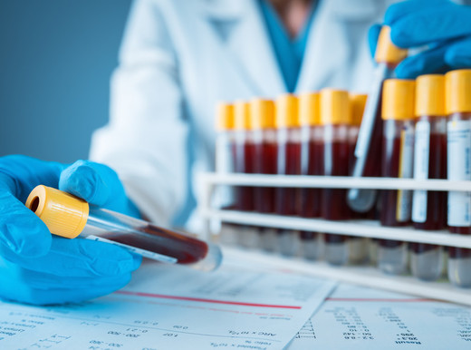 Trapianto di cuore, biopsia liquida per svelare il rischio rigetto